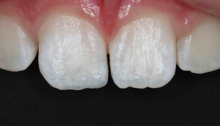 Dental Restorations For Front Teeth